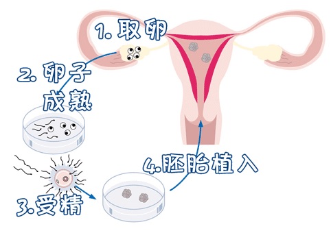 体外受精 IVF-ET